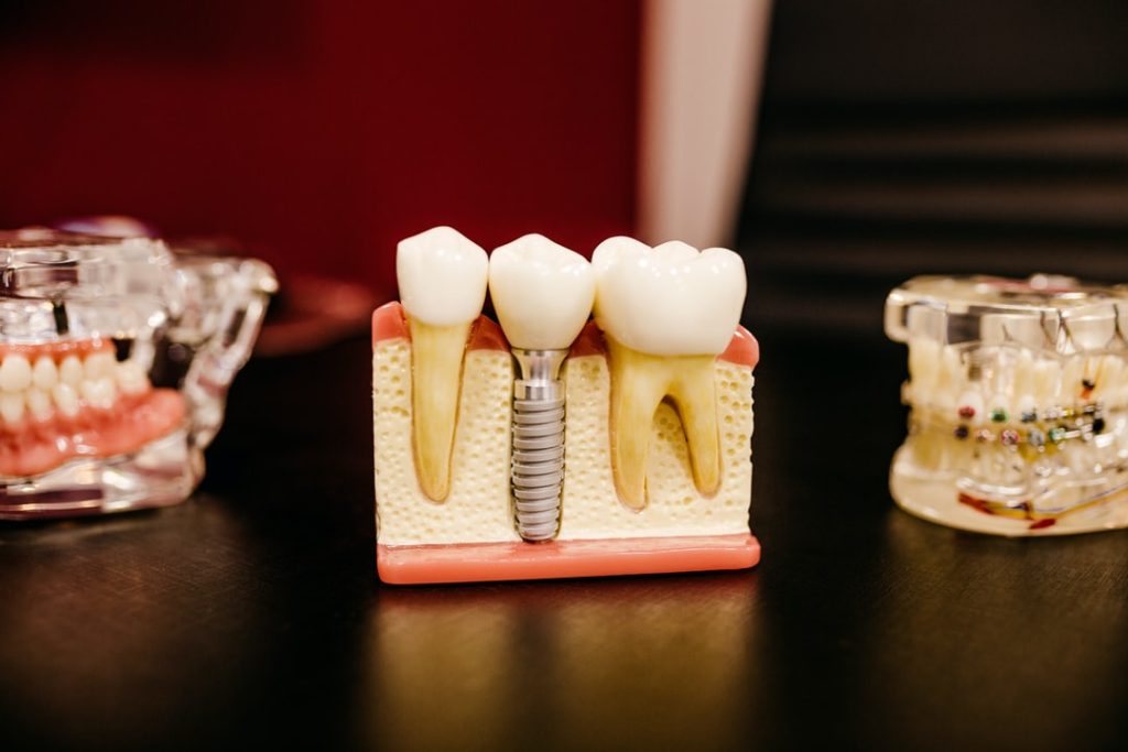 choose dental implants