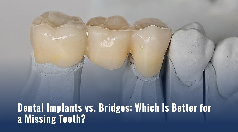 Close-up of a three-unit ceramic dental bridge seated on a dental model beside natural teeth