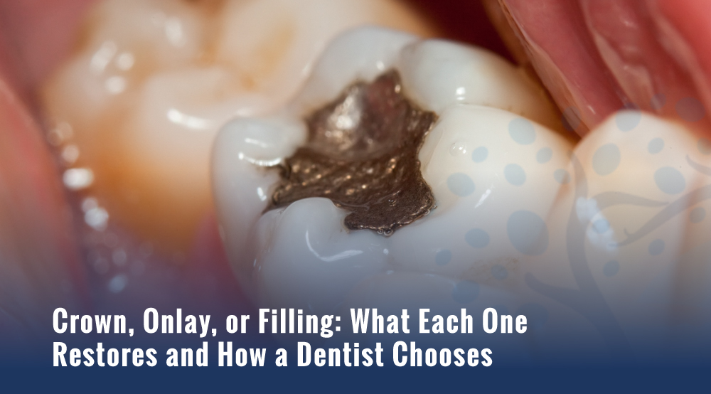 dental crowns vs fillings